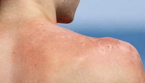 Cách cứu chữa làn da bị cháy nắng hiệu quả nhất tại nhà-2