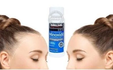 thuoc-moc-toc-minoxidil-co-tot-khong-su-that-tu-chuyen-gia1