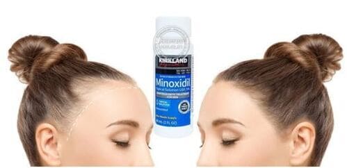 thuoc-moc-toc-minoxidil-co-tot-khong-su-that-tu-chuyen-gia1