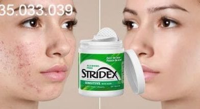 alcohol-free-stridex-maximum-review-chi-tiet-co-dang-mua-khong1